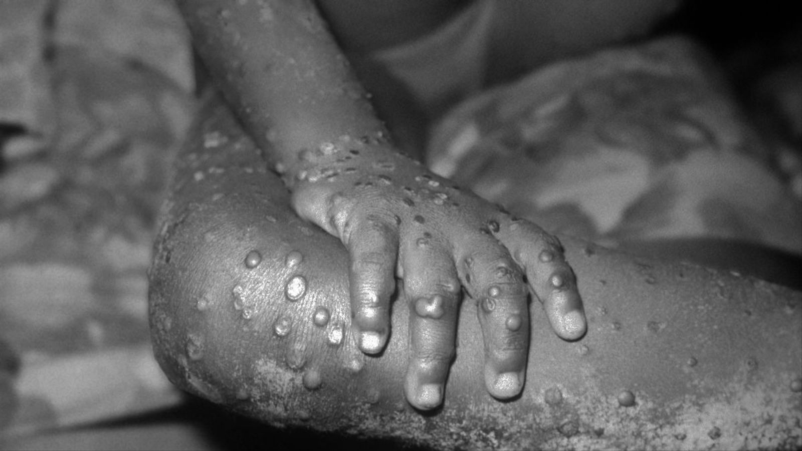 OMS: Casi 200 casos de viruela símica en más de 20 países