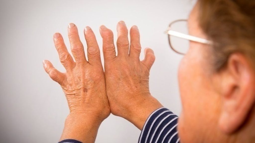 Mil millones de personas sufrirán osteoartritis en 2050, según un estudio