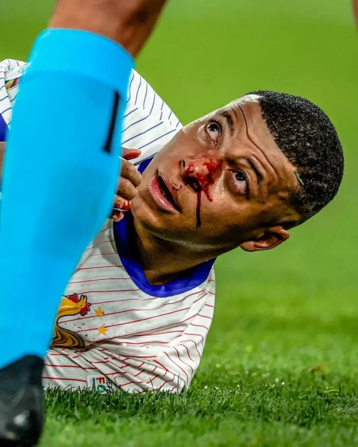 Mbappé sufre fractura nasal y pone en riesgo la Eurocopa