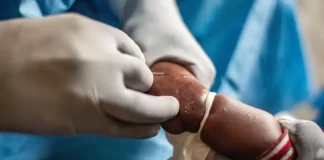 Venezuela refuerza vigilancia epidemiológica para contener la mpox