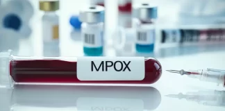 Detectan posible variante respiratoria del virus Mpox