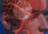 Nanorobots para tratar aneurismas cerebrales