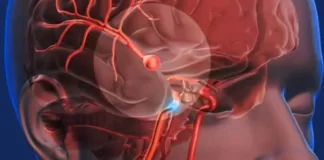 Nanorobots para tratar aneurismas cerebrales