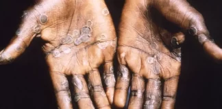 La OMS mantiene la emergencia por la mpox ante el elevado número de casos