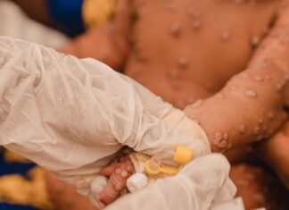 Unión Africana mantiene emergencia por mpox ante aumento de casos y falta de fondos